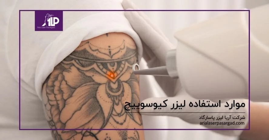 استفاده از لیزر کیوسوییچ